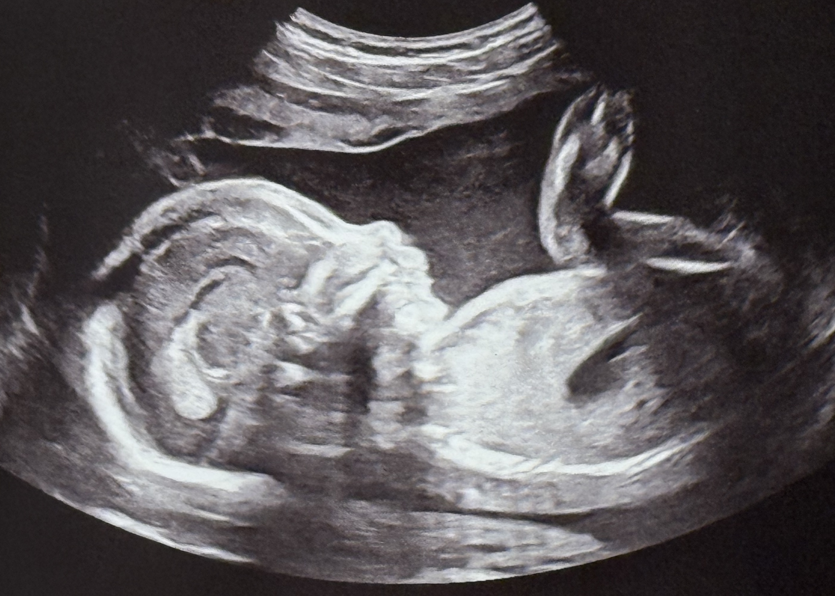 A picture of a fetal ultrasound.